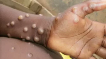 زيادة وفيات فيروس جدري القرود mpox في 26 دولة.. الصحة العالمية تعلن