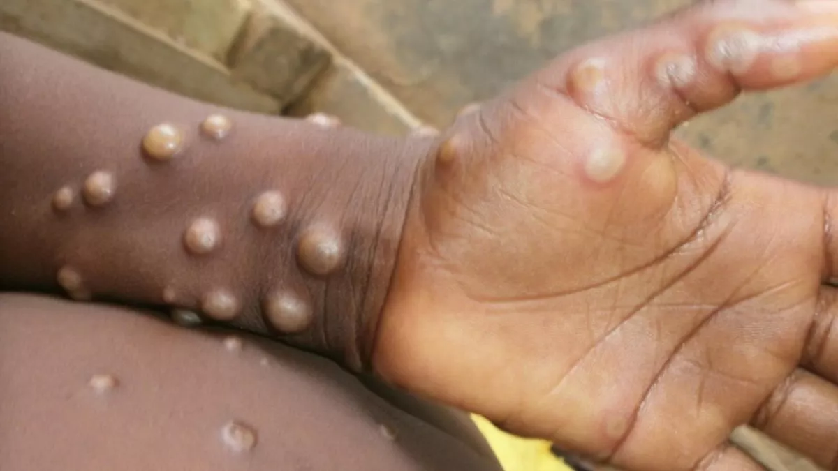 زيادة وفيات فيروس جدري القرود mpox في 26 دولة.. الصحة العالمية تعلن